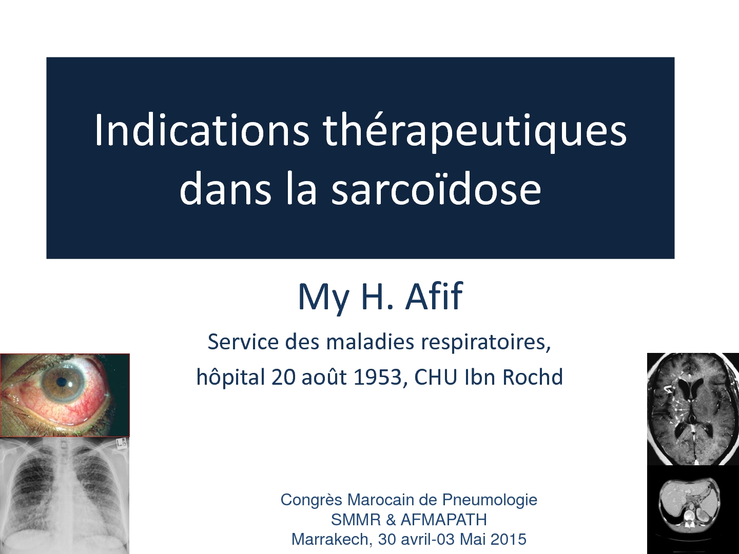 Indications thérapeutiques dans la sarcoïdose. H. AFIF