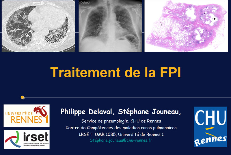 Traitement de la FPI. Philippe Delaval