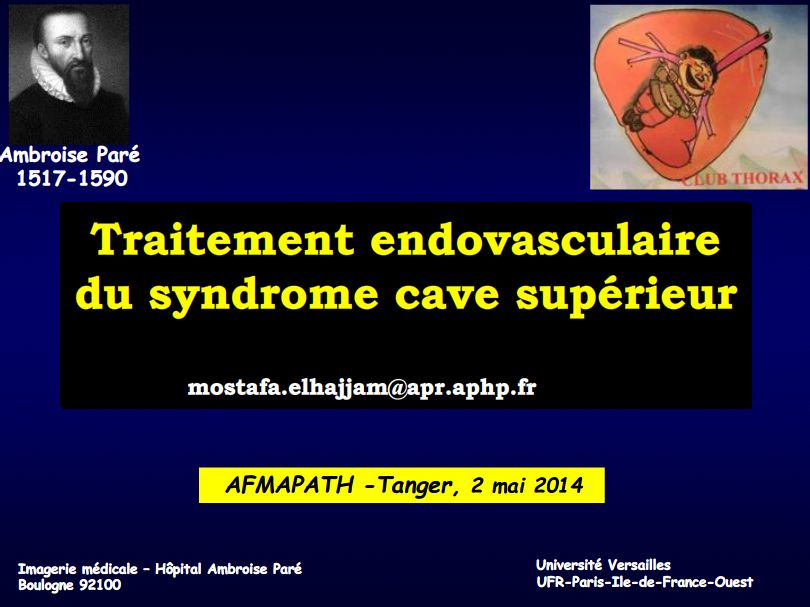Traitement endovasculaire du syndrome cave supérieur. Mustapha El Hajjam