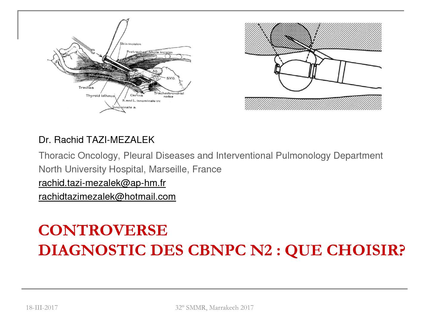 Diagnostic des CBNPC N2 : Que choisir ? Pour EBUS : R. TAZI MEZAlEK (Marseille)