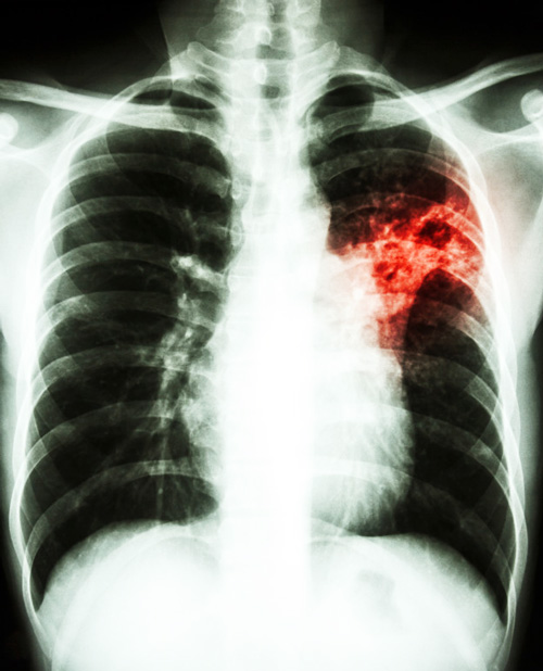 TB Xray